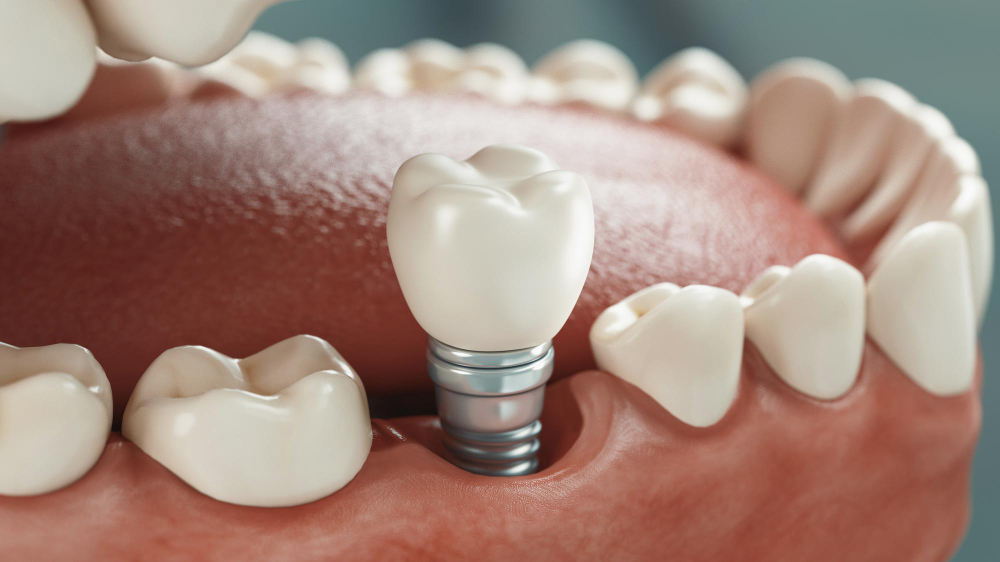 Dental Implants in Clark